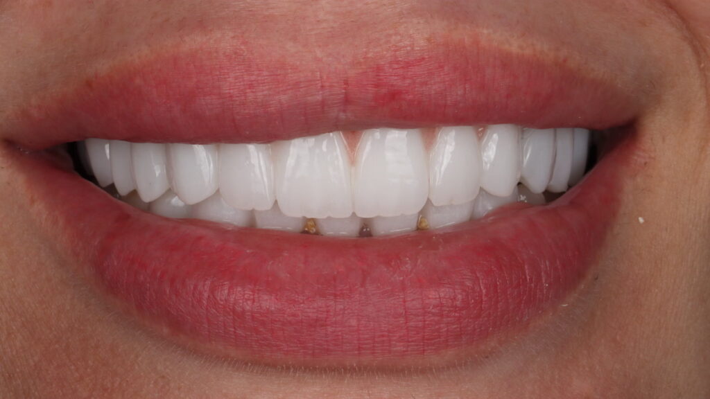A natural-looking smile achieved with veneers at Camellia Polyclinic.