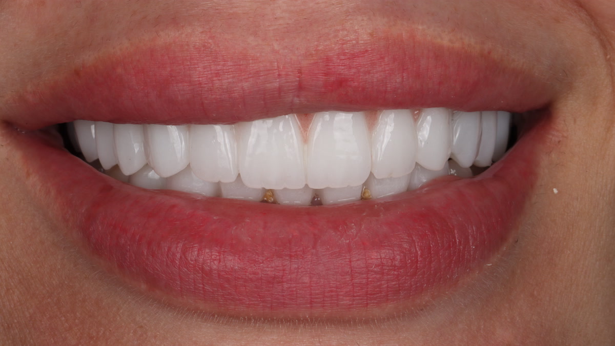 A natural-looking smile achieved with veneers at Camellia Polyclinic.