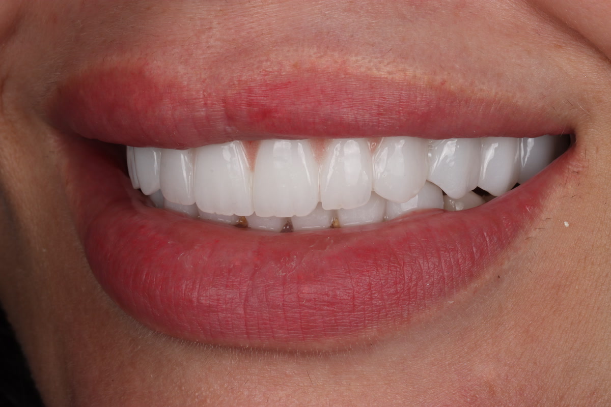 A natural-looking veneers result at Camellia Polyclinic in Beirut
