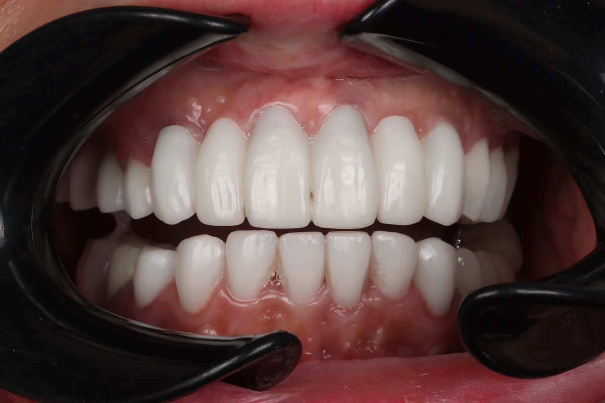 Clinical view of finished veneers, shaped and shaded to look natural