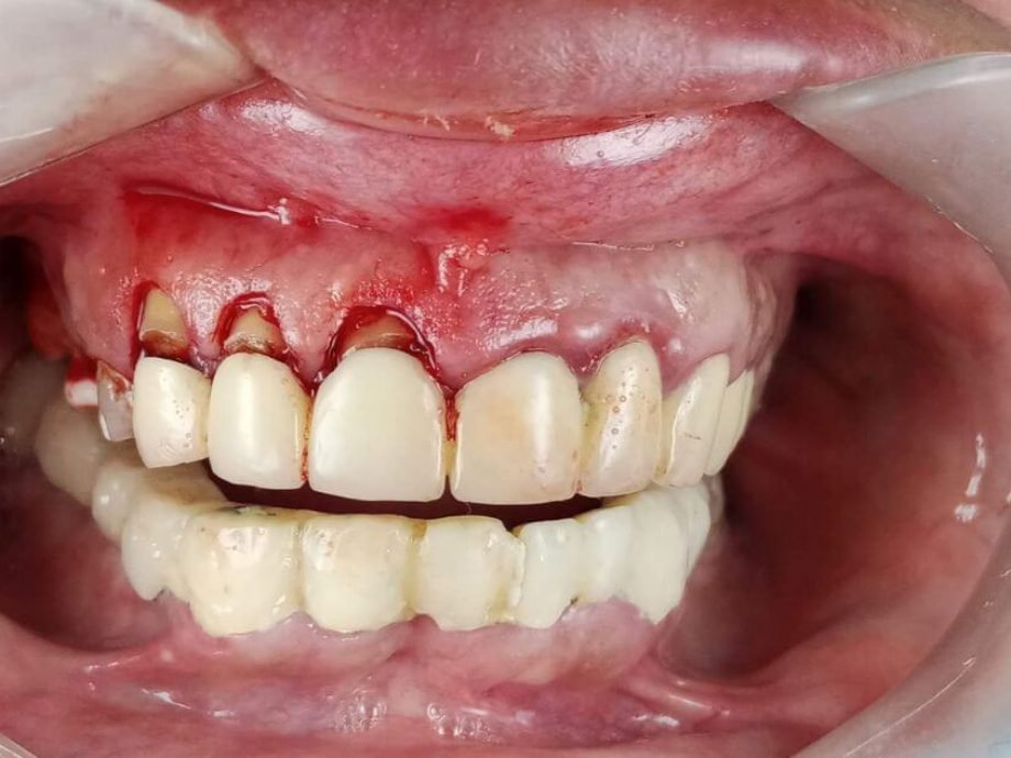 Zoom in of a mouth before dental surgery