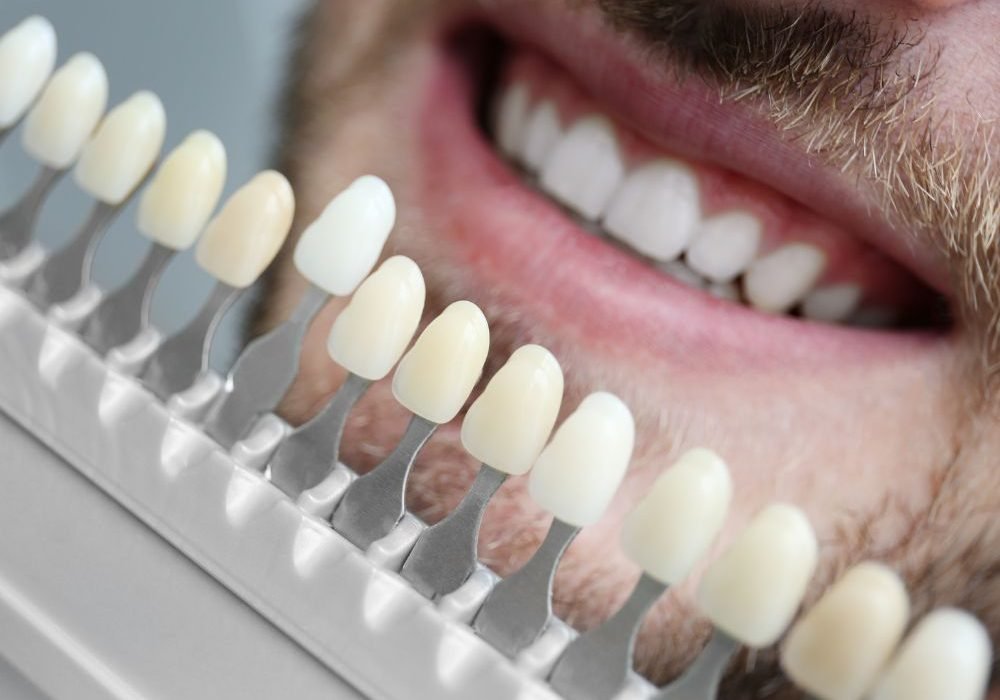 A patient after composite veneer with the teeth shade guide that choose from it