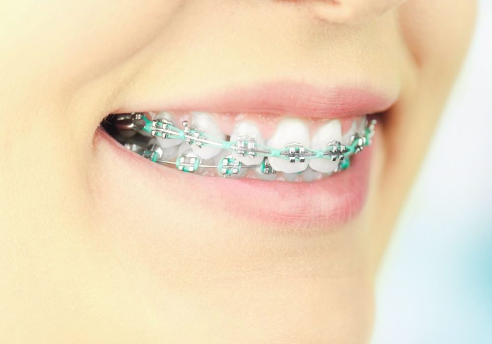 A braces girl smiling during orthodontic treatments