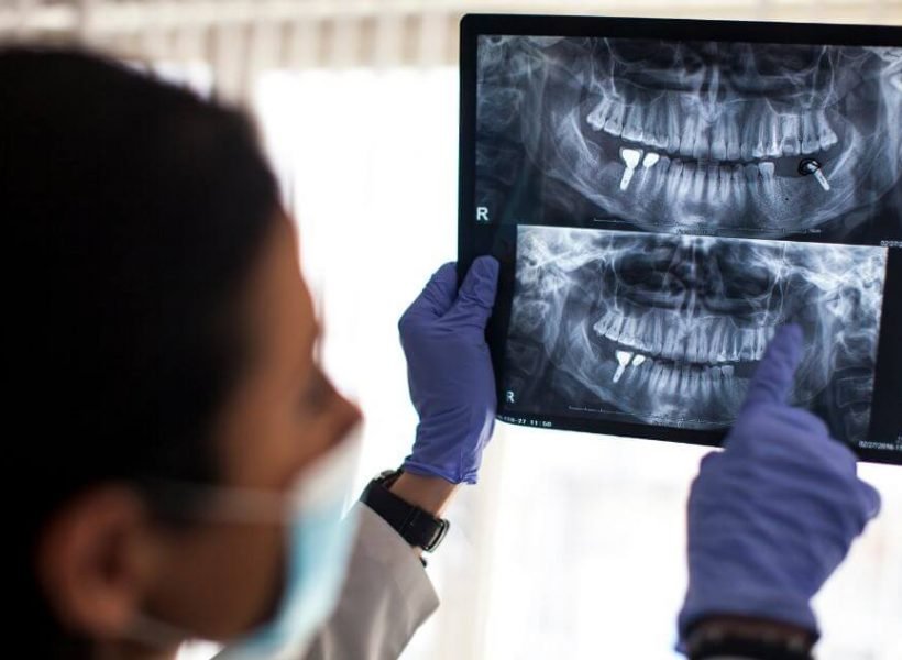 doctor showing x-ray images of dental implant